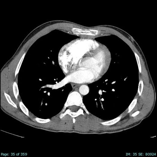 Sternal fractures in blunt chest trauma: Diagnostic value of CT and clinical and radiological insights