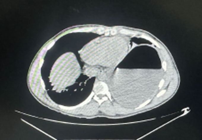 Giant infected bronchogenic cyst mimicking lung abscess in a young adult
